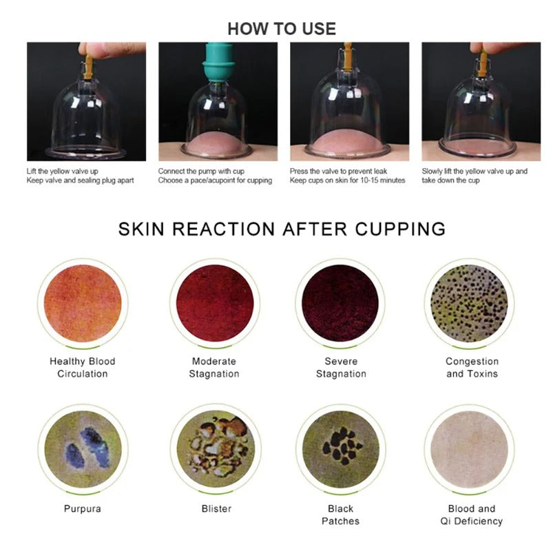 Premium Vacuum Cupping Therapy Set – 6, 12, or 24 Plastic Suction Cups for Massage, Relaxing Muscles, Pain Relief, and Well-Being, Safe Alternative to Traditional Cupping, Durable Quality